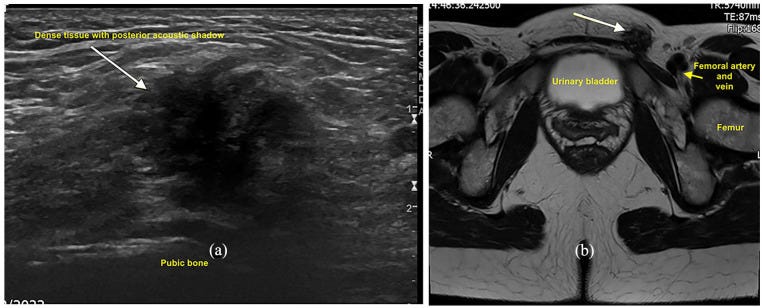 Hernia parte VII Ecografia tempo formacion.jpg